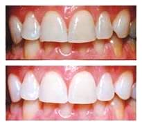 Teeth Whitening Procedure Visual