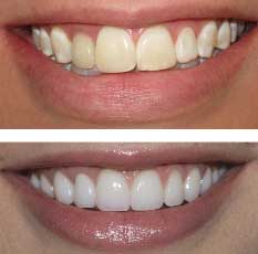 Porcelain Veneers