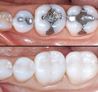 Tooth Coloured Composite Restoration