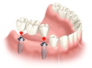 Missing Teeth Replacement Options