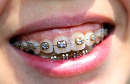 Orthodontic Treatment: Removable Appliances