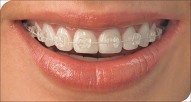Six Month Smiles Cosmetic Orthodontics