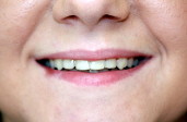 After Smile Alignment