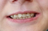 Before Orthodontics